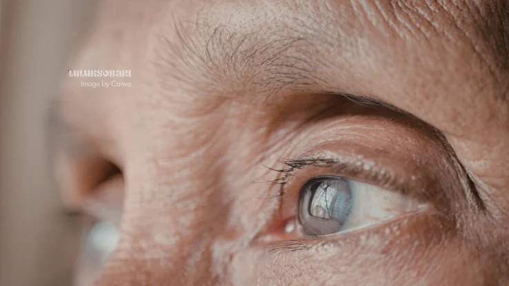 penyebab katarak mata